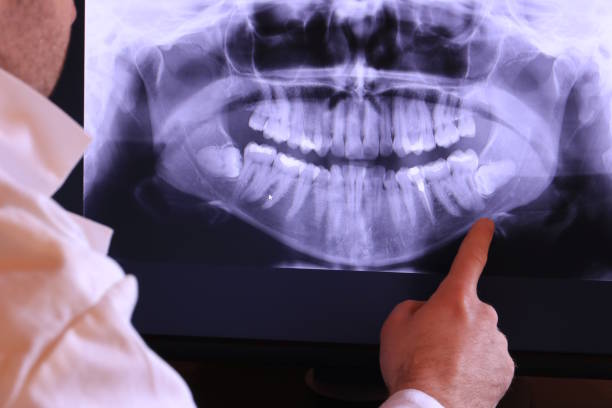 Best Emergency Tooth Extraction in Brownsville, OR