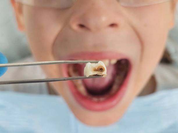 Best Urgent Care for Lost Fillings or Crowns in Brownsville, OR
